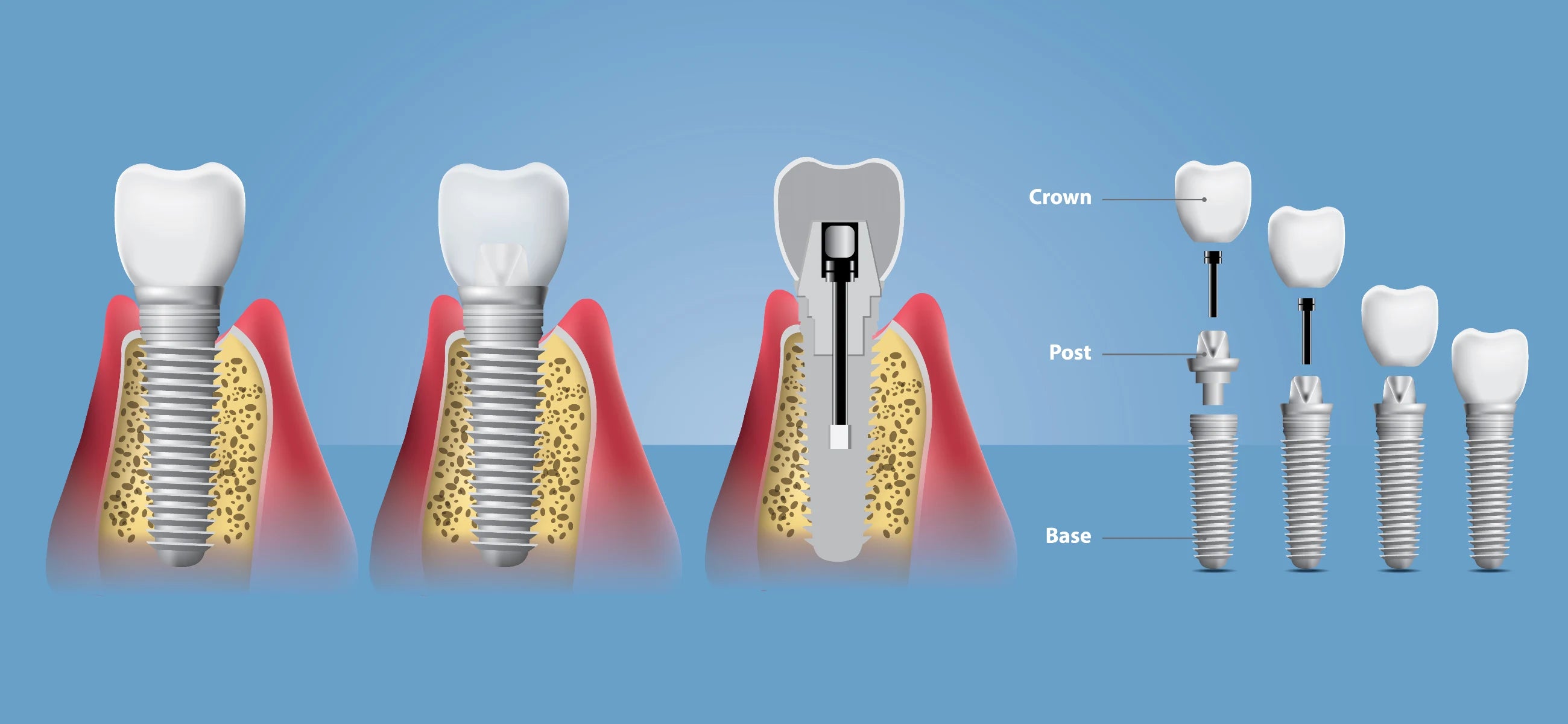 The definitive dental crown guide: Types, costs, and definition included