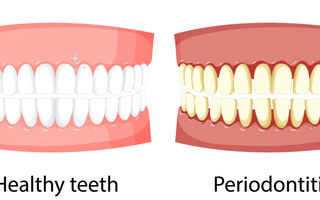Causes, symptoms, and everything of periodontal disease