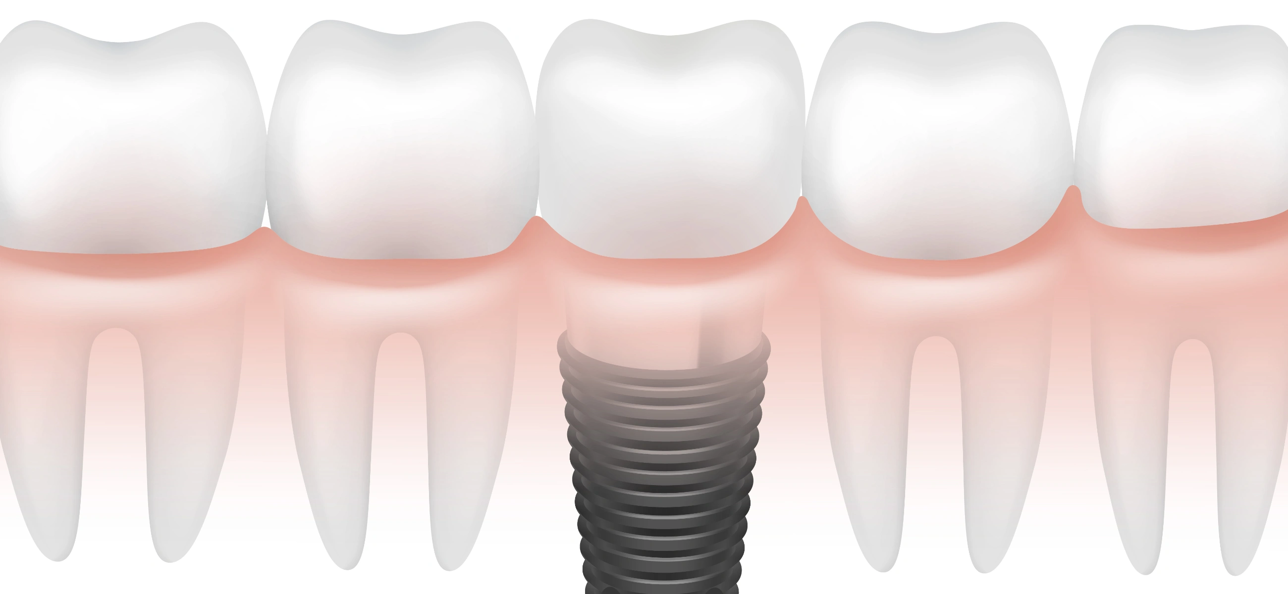 Dental implants VS dentures: Which is better for you?