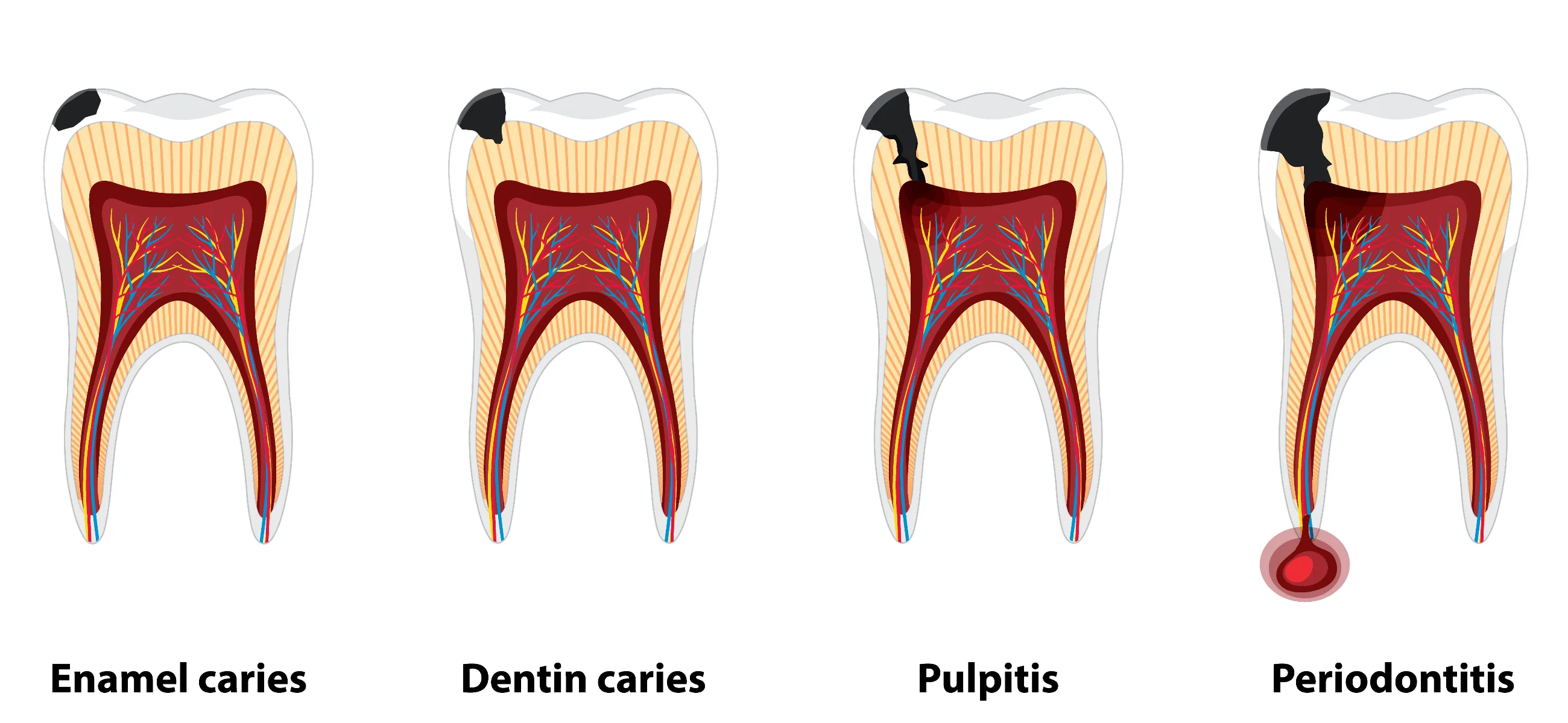 4 ways to stop tooth decay from spreading - home remedies