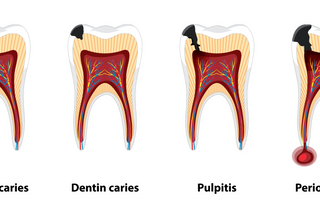 4 ways to stop tooth decay from spreading - home remedies