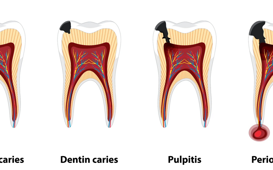 4 ways to stop tooth decay from spreading - home remedies