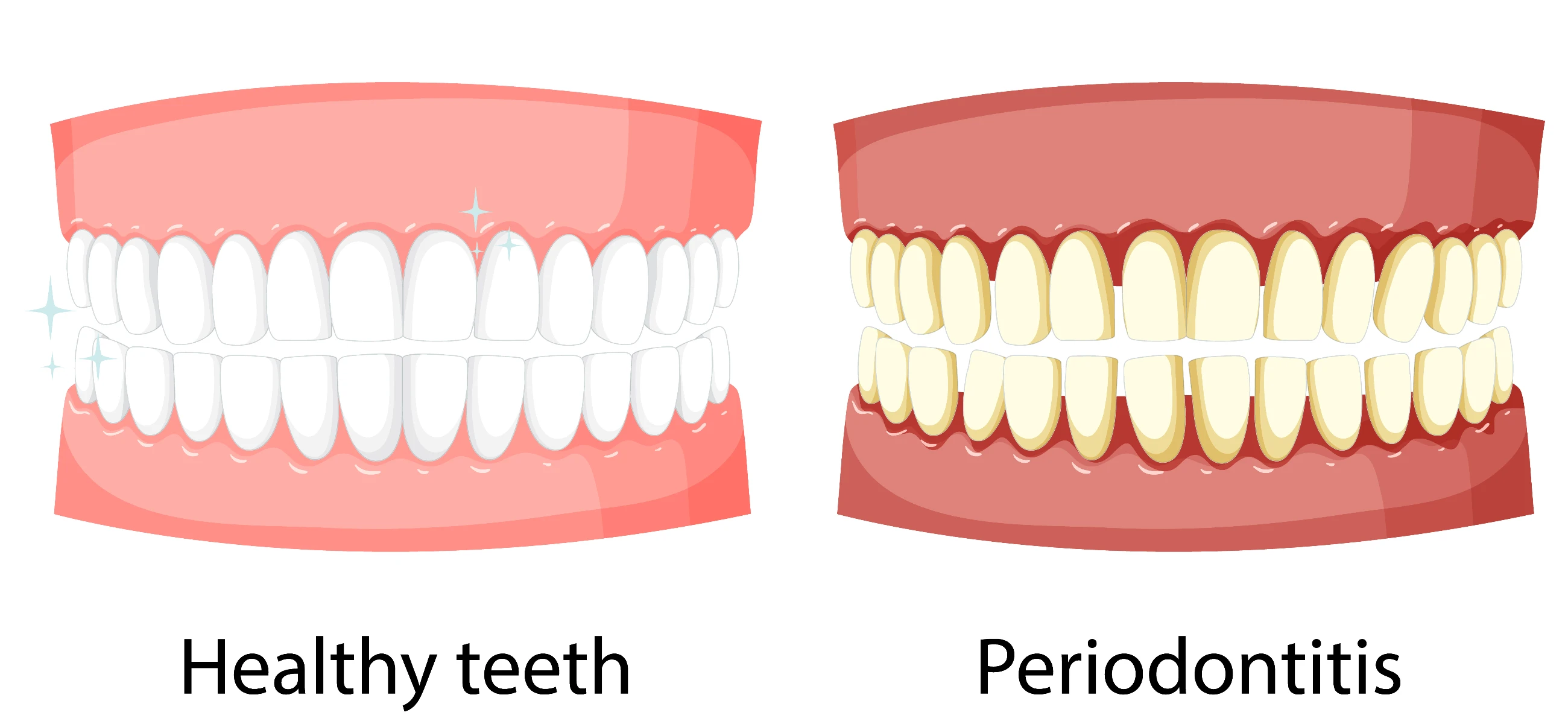 Causes, symptoms, and everything of periodontal disease